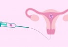 Popular Reproductive Surgeries to help with Infertility