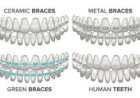 What are the different types of dental braces and which is best for you?