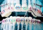What is the Ideal Age for Wearing Dental Braces?