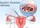 PCOS and Infertility