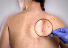 Rubella : How it can have an impact on your pregnancy!