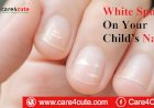 White Spots On Your Child’s Nail – Should You Be Worried?