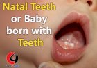 Natal Teeth or Baby Born With Teeth