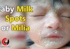 Baby Milk Spot Or Milia