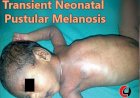 Transient Neonatal Pustular Melanosis