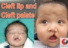 Cleft Lip and Cleft Palate: Cause, Symptoms, Treatment