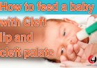 How to Feed A Baby With Cleft Lip And Cleft Palate