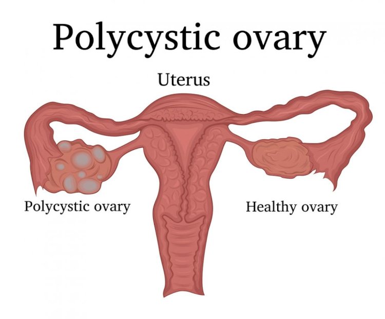 How Polycystic Ovary Syndrome (PCOS) Affects Infertility?