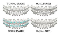 What are the different types of dental braces and which is best for you?