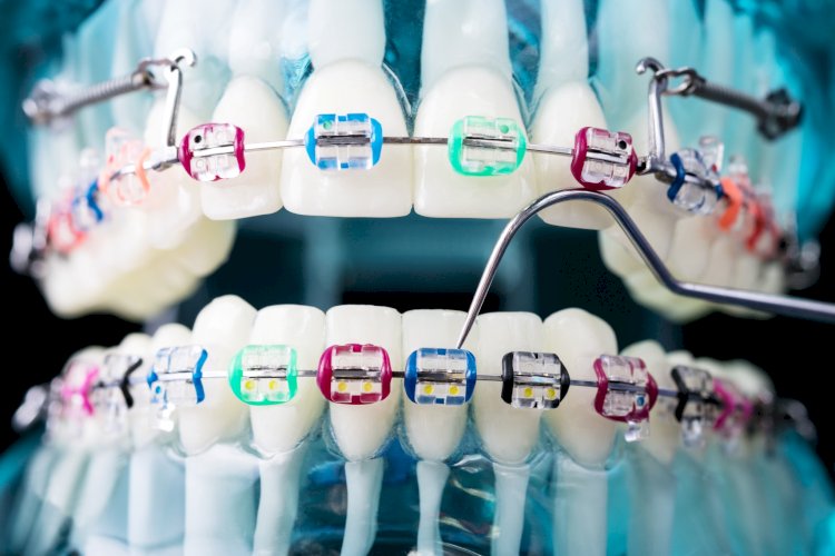 What is the Ideal Age for Wearing Dental Braces?