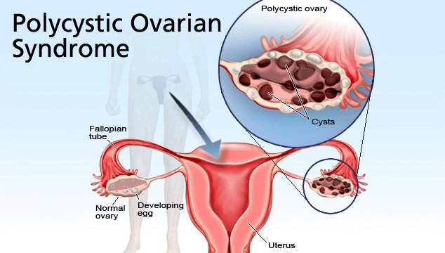 PCOS and Infertility