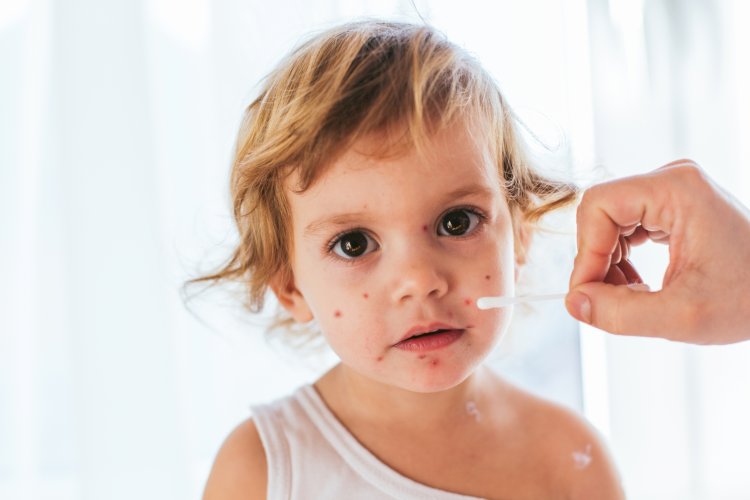 Chickenpox Vaccine : What You Need to Know