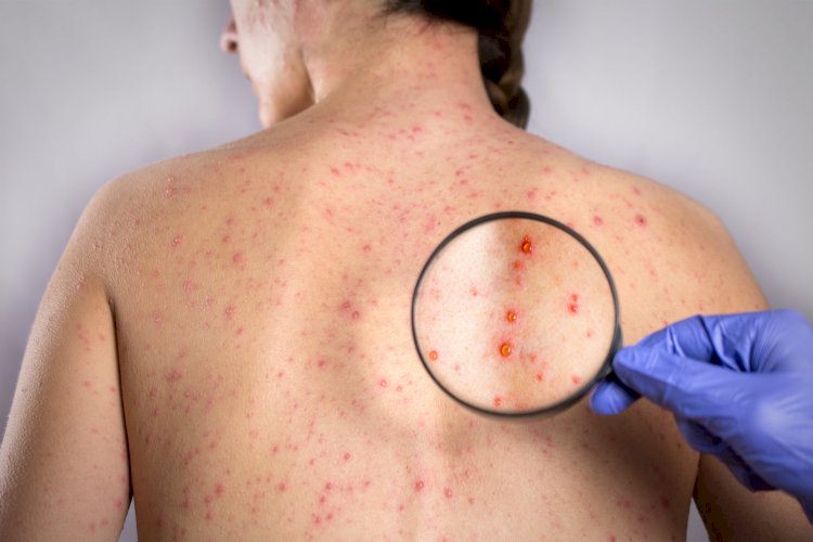 Rubella : How it can have an impact on your pregnancy!