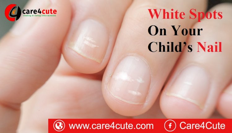 White Spots On Your Child’s Nail – Should You Be Worried?