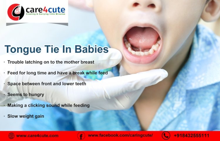 Tongue-tie in babies