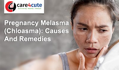 Pregnancy Melasma (Chloasma): Causes And Remedies
