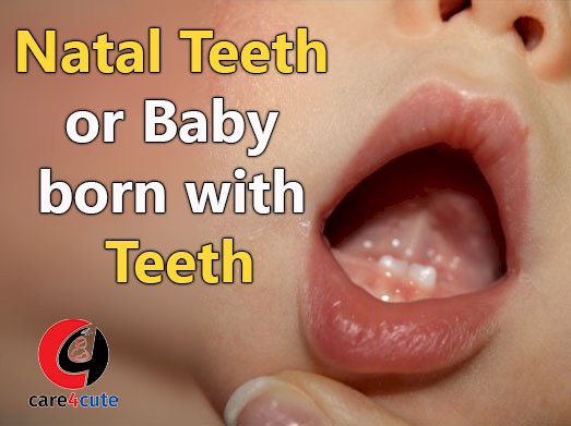 Natal Teeth or Baby Born With Teeth