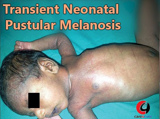 Transient Neonatal Pustular Melanosis