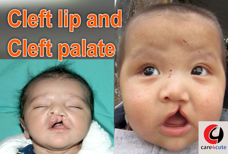 Cleft Lip and Cleft Palate: Cause, Symptoms, Treatment