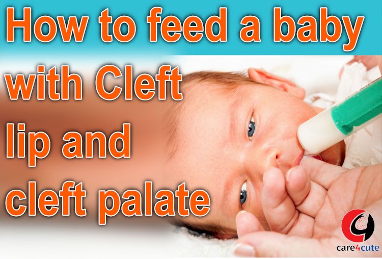 How to Feed A Baby With Cleft Lip And Cleft Palate