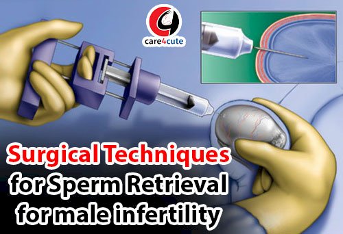 Surgical Techniques for Sperm Retrieval for male infertility
