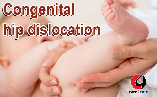 Congenital Hip Dislocation in Newborn