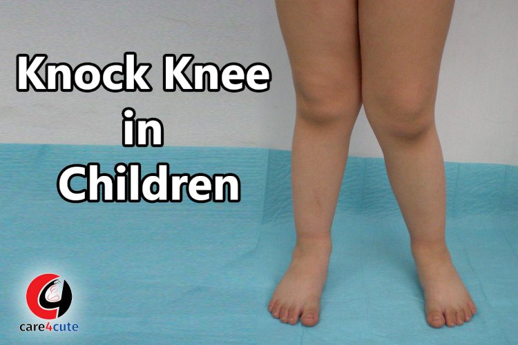 Knock Knees in Children