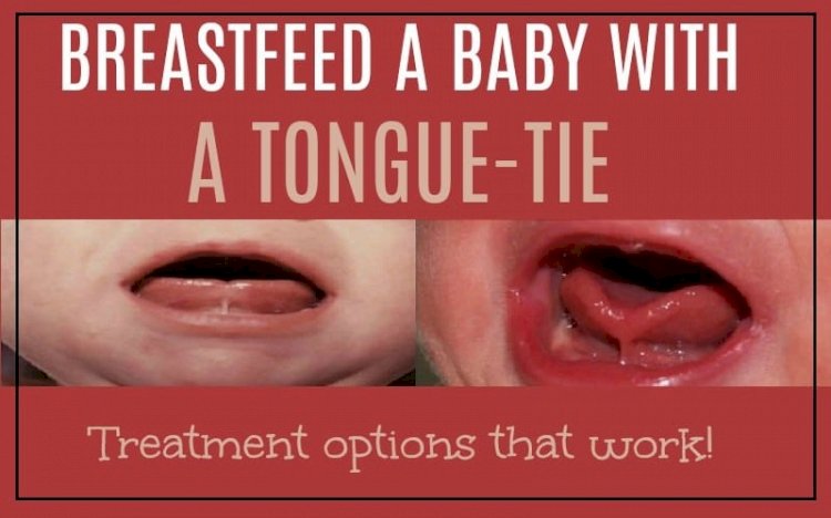 Tongue-tie in Kids