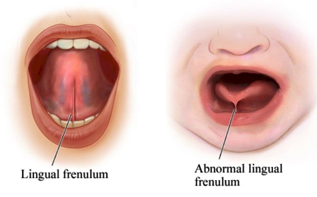 Tongue-tie in Kids