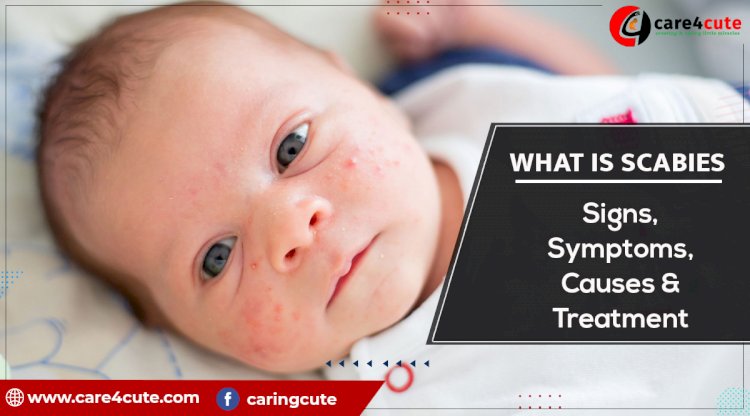 What is Scabies and how it is treated?